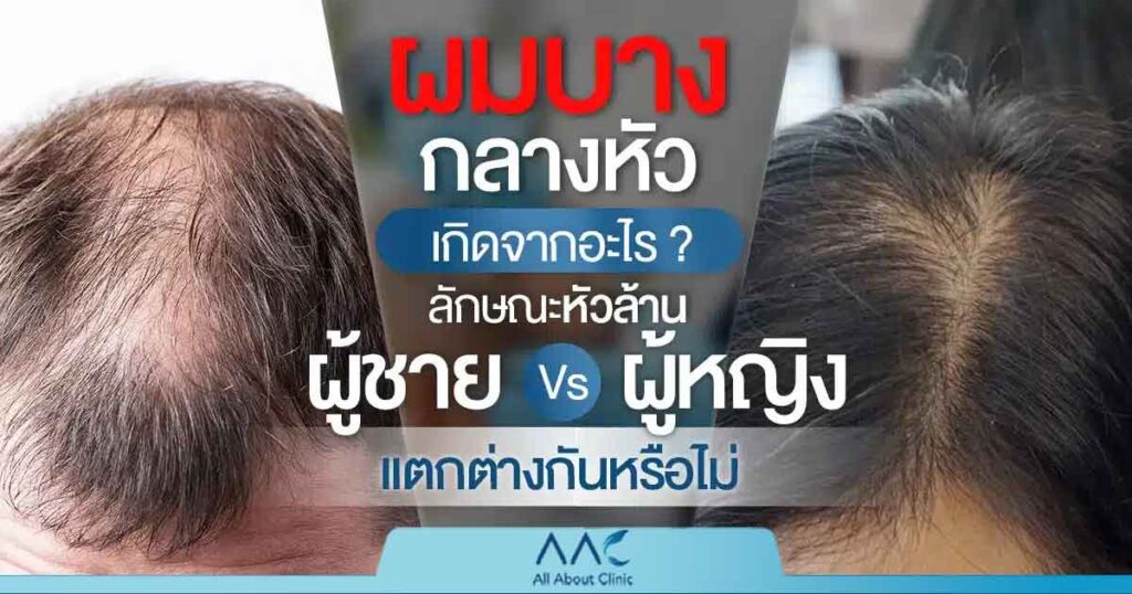 ผมบางกลางหัว