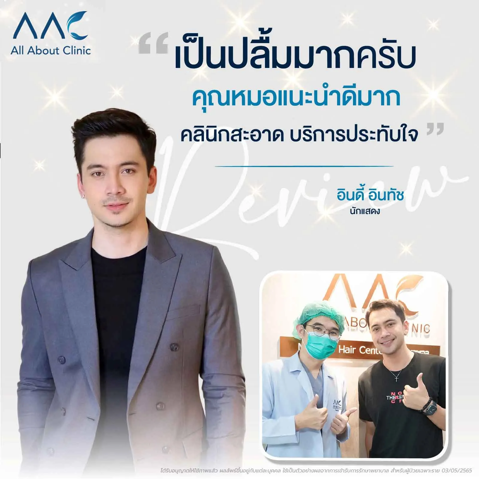รีวิวปลูกผม คุณอินดี้ อินทัช ดาราชาย