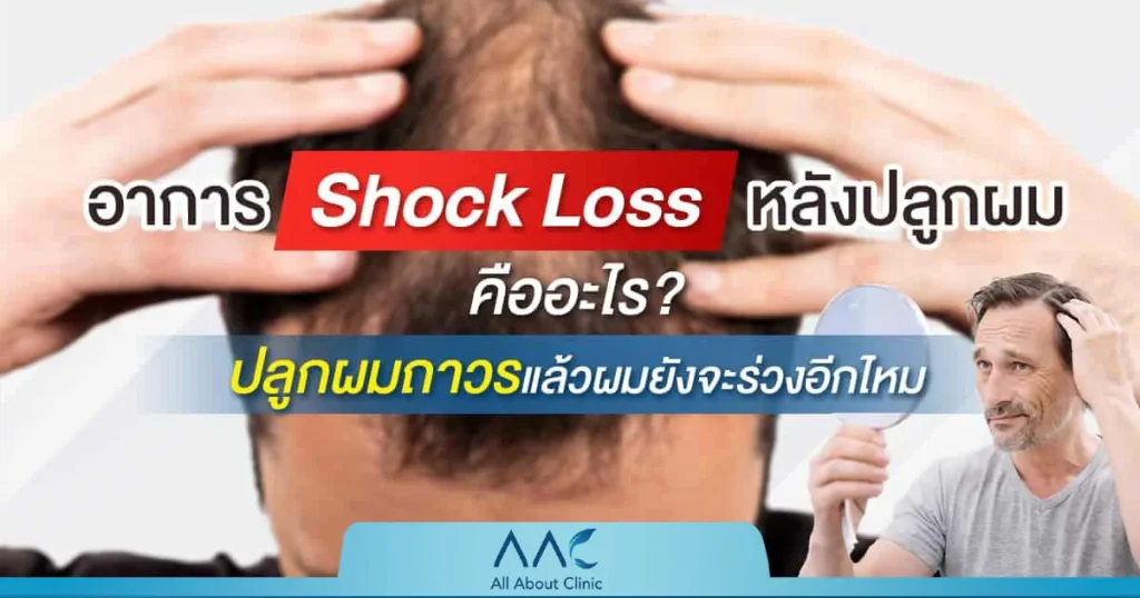 shock loss หลังปลูกผม