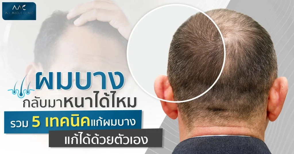 แก้ผมบาง