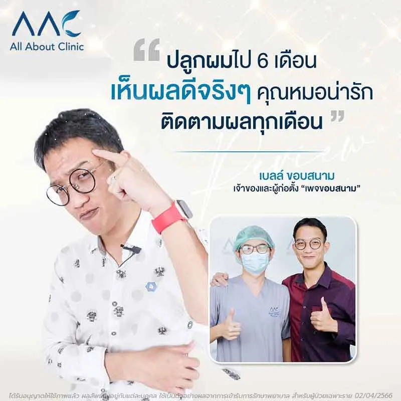 รีวิวปลูกผม คุณเบลล์ ขอบสนาม เจ้าของเพจขอบสนาม