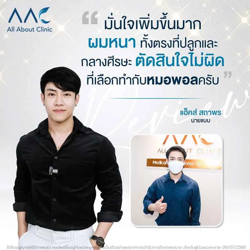 รีวิวหลังปลูกผม คุณแฮ็คส์ สถาพร นายแบบ