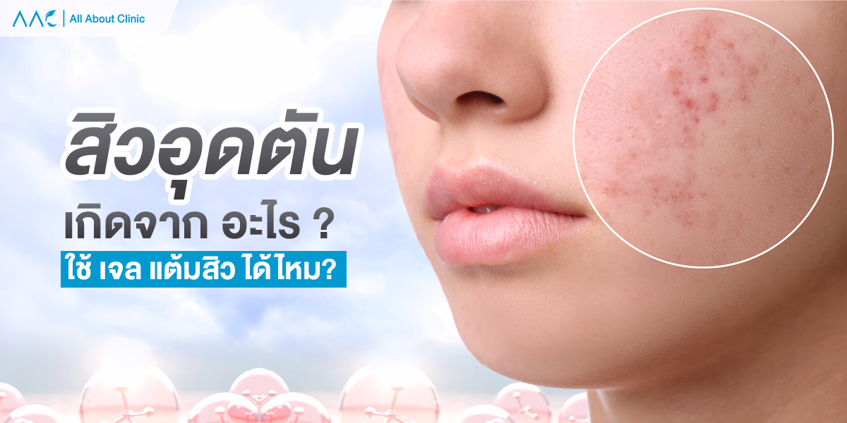 สิวอุดตัน
