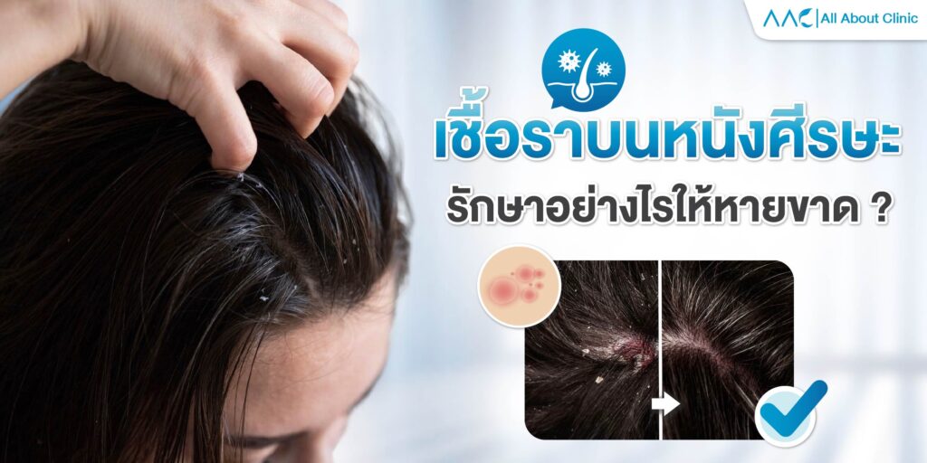 รักษา เชื้อราบนหนังศีรษะ
