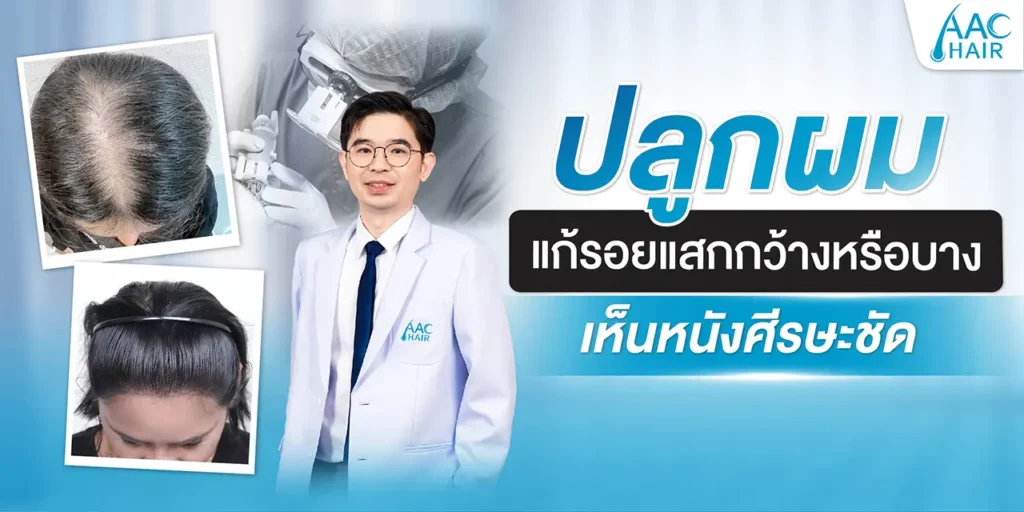ปลูกผม แก้รอยแสกกว้างหรือบาง เห็นหนังศีรษะชัด