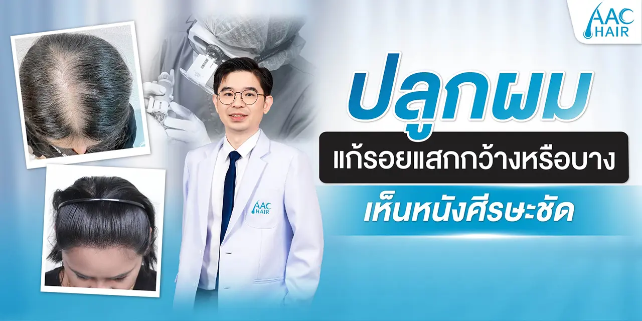 ปลูกผม แก้รอยแสกกว้างหรือบาง เห็นหนังศีรษะชัด