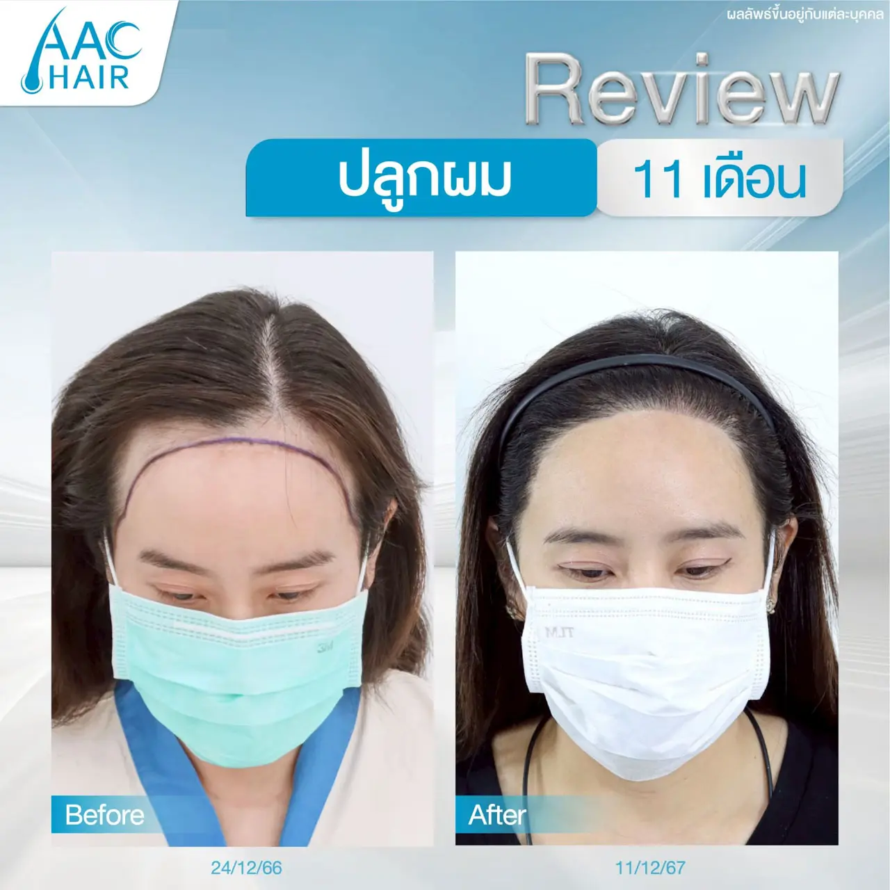 รีวิวหลังปลูกผม ผู้หญิง 11 เดือน เพื่อแนวผมที่ลงตัว
