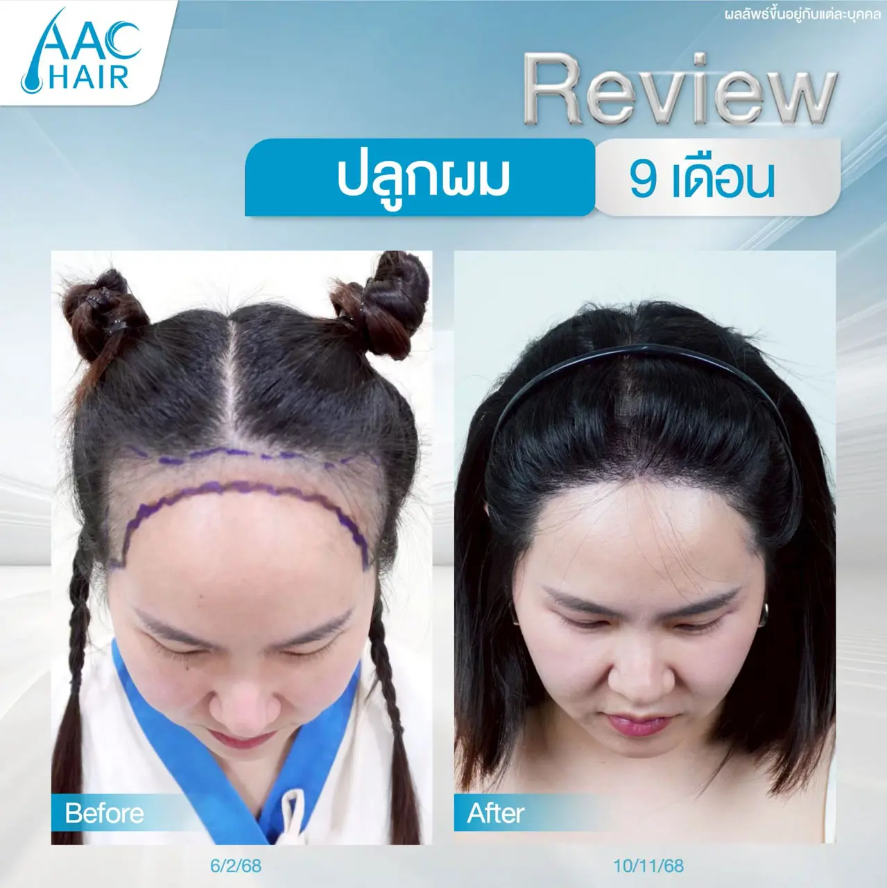 รีวิวหลังปลูกผม ผู้หญิง 9 เดือน แก้ผมเว้าผมบาง