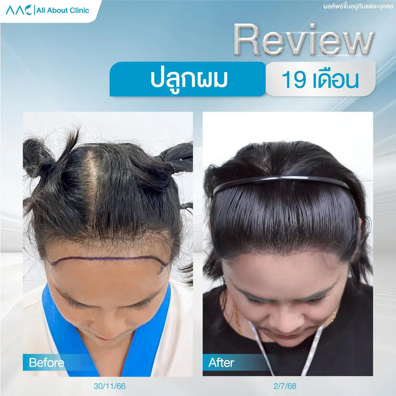 รีวิวหลังปลูกผม ผู้หญิง 19 เดือน แก้ผมเว้าผมร่วง