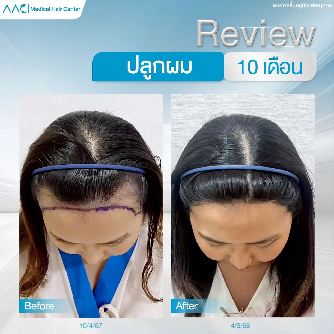 รีวิวหลังปลูกผม ผู้หญิง 10 เดือน แก้ผมเว้า แนวผมไม่ได้สัดส่วน