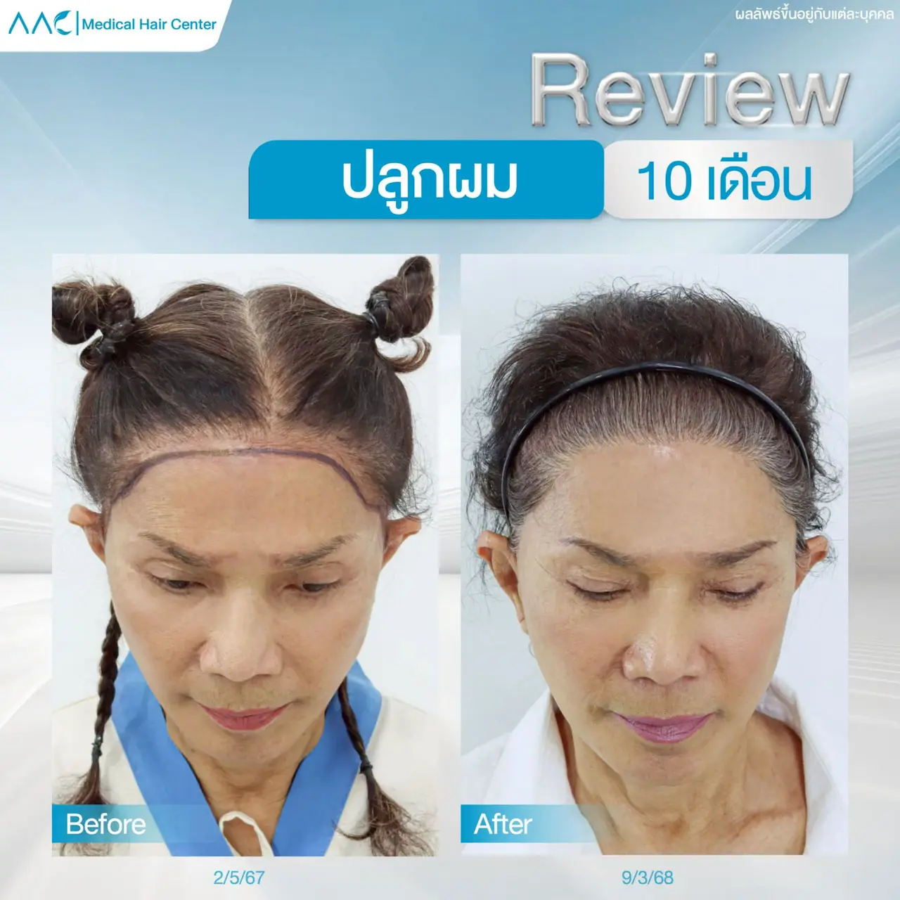 รีวิวหลังปลูกผม ผู้หญิง 10 เดือน เพื่อแนวผมที่ลงตัวขึ้น
