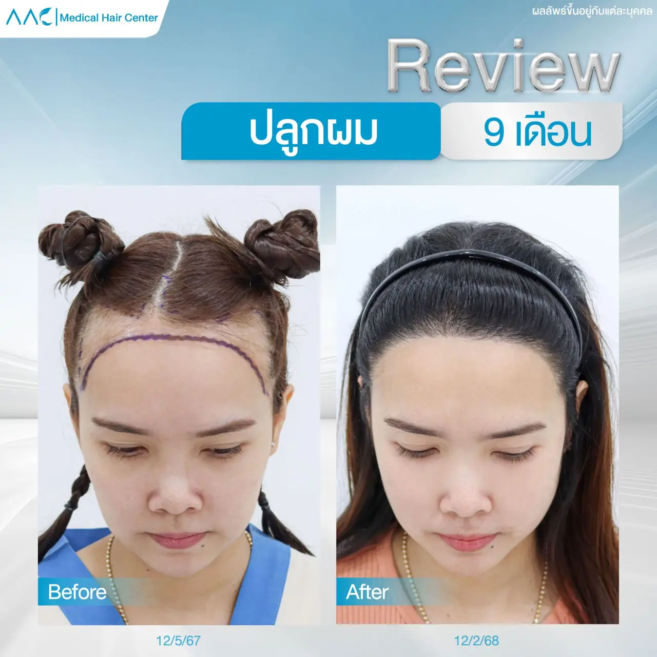 รีวิวหลังปลูกผม ผู้หญิง 9 เดือน ผมดกเต็ม จัดทรงง่ายขึ้น