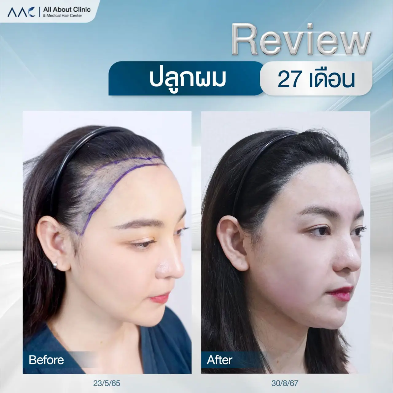 รีวิวหลังปลูกผม ผู้หญิง 27 เดือน แก้หน้าผากกว้าง