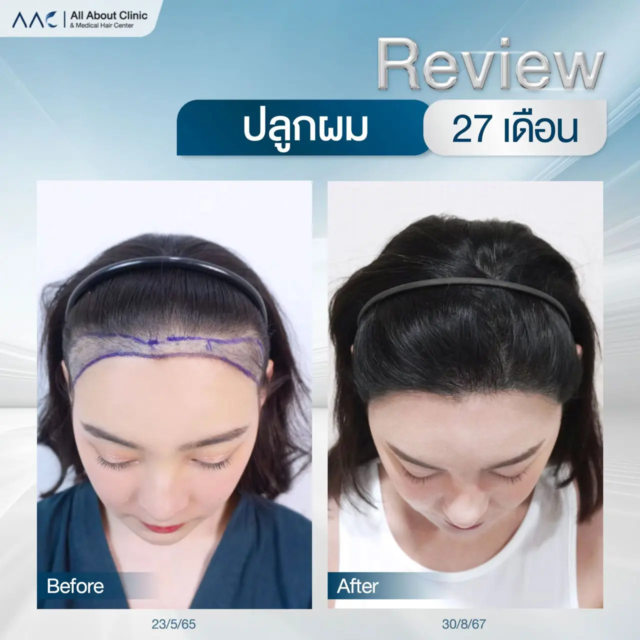 รีวิวหลังปลูกผม ผู้หญิง 27 เดือน เติมไรผมให้เต็มสวย