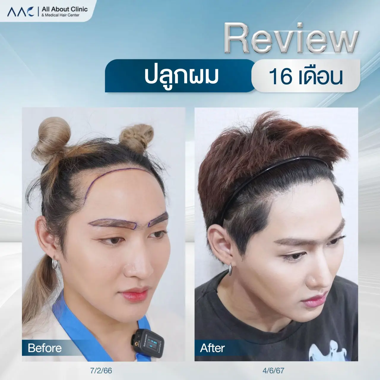 รีวิวหลังปลูกผม ปลูกคิ้ว ผู้หญิง 16 เดือน