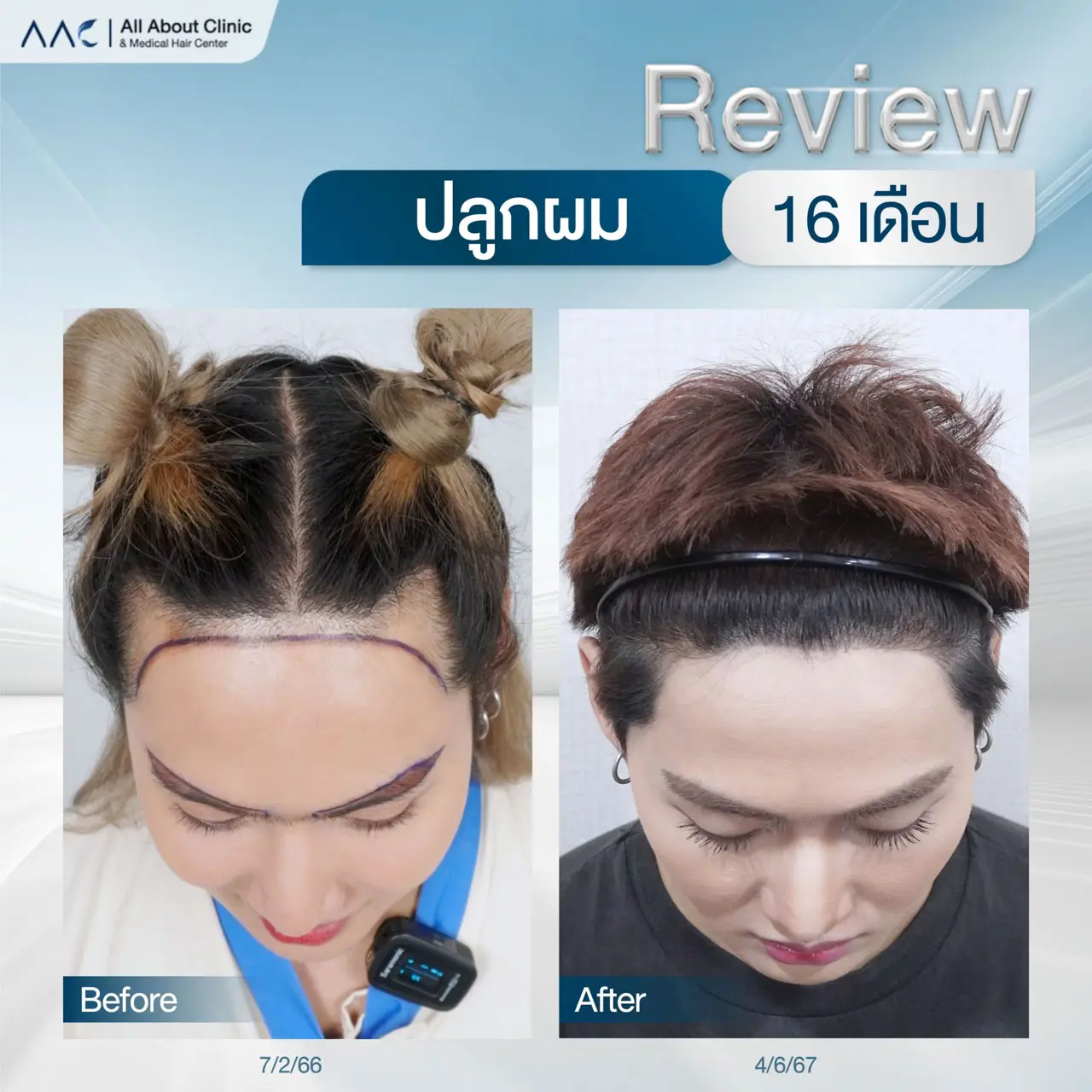 รีวิวหลังปลูกผม ปลูกคิ้ว ผู้หญิง 16 เดือน