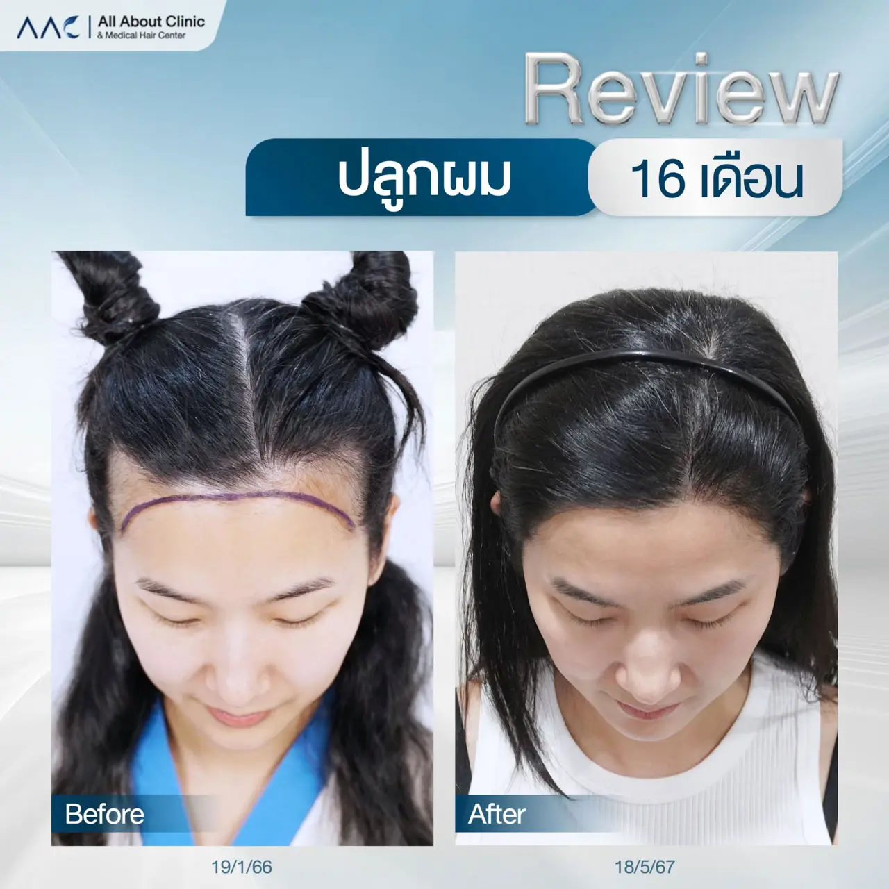 รีวิวหลังปลูกผม ผู้หญิง 16 เดือน เปรียบเทียบก่อนหลัง