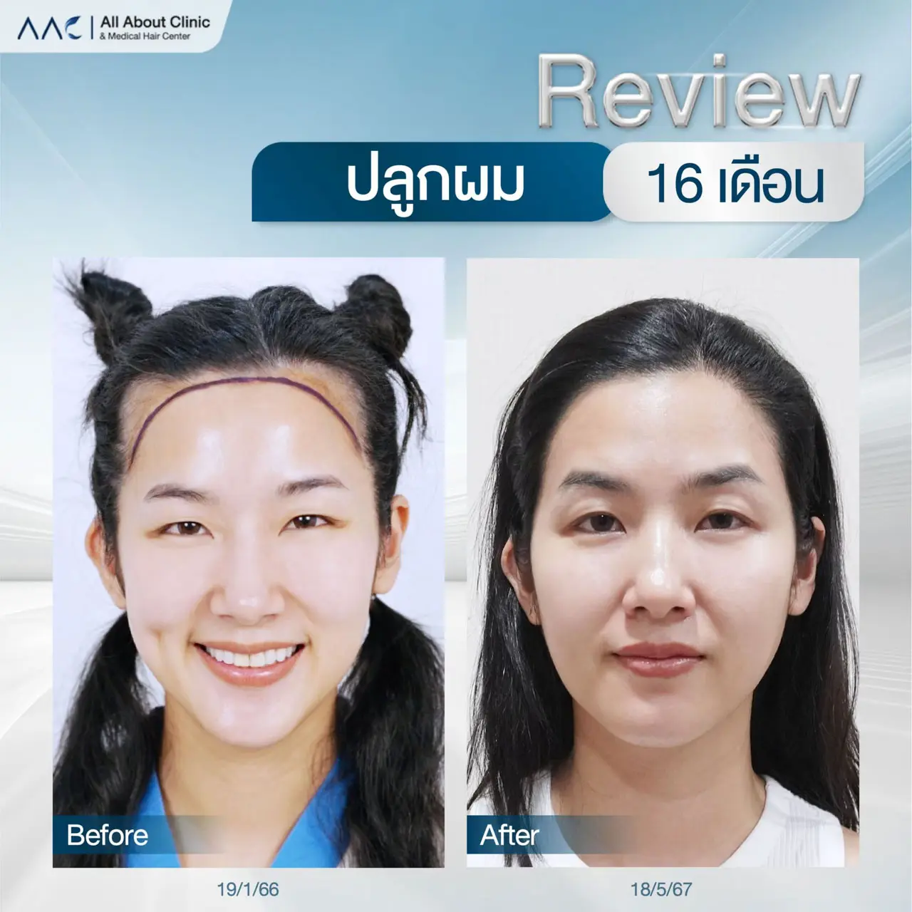 รีวิวหลังปลูกผม ผู้หญิง 16 เดือน เติมไรผม ปรับกรอบหน้า