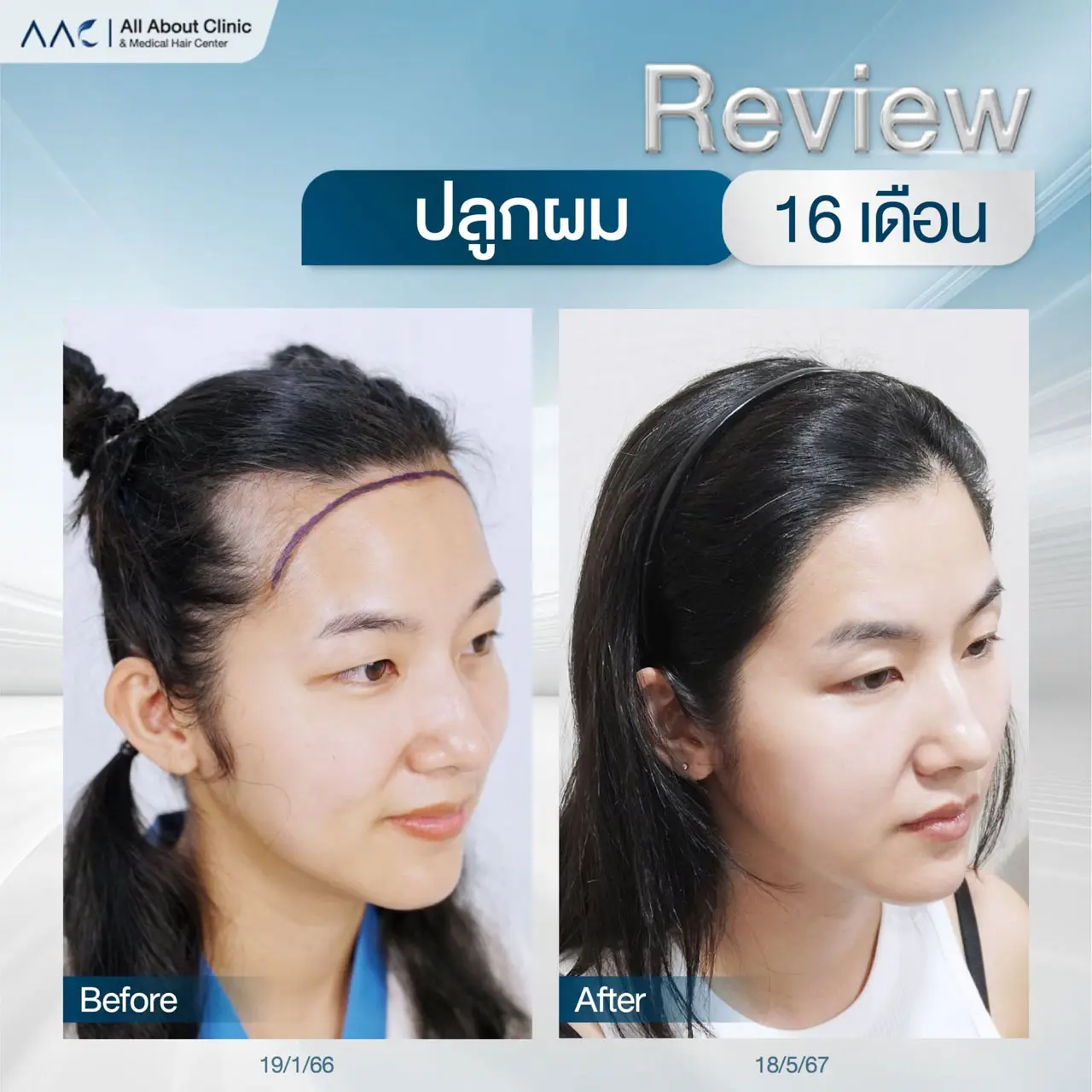 รีวิวหลังปลูกผม ผู้หญิง 16 เดือน ปรับกรอบหน้า