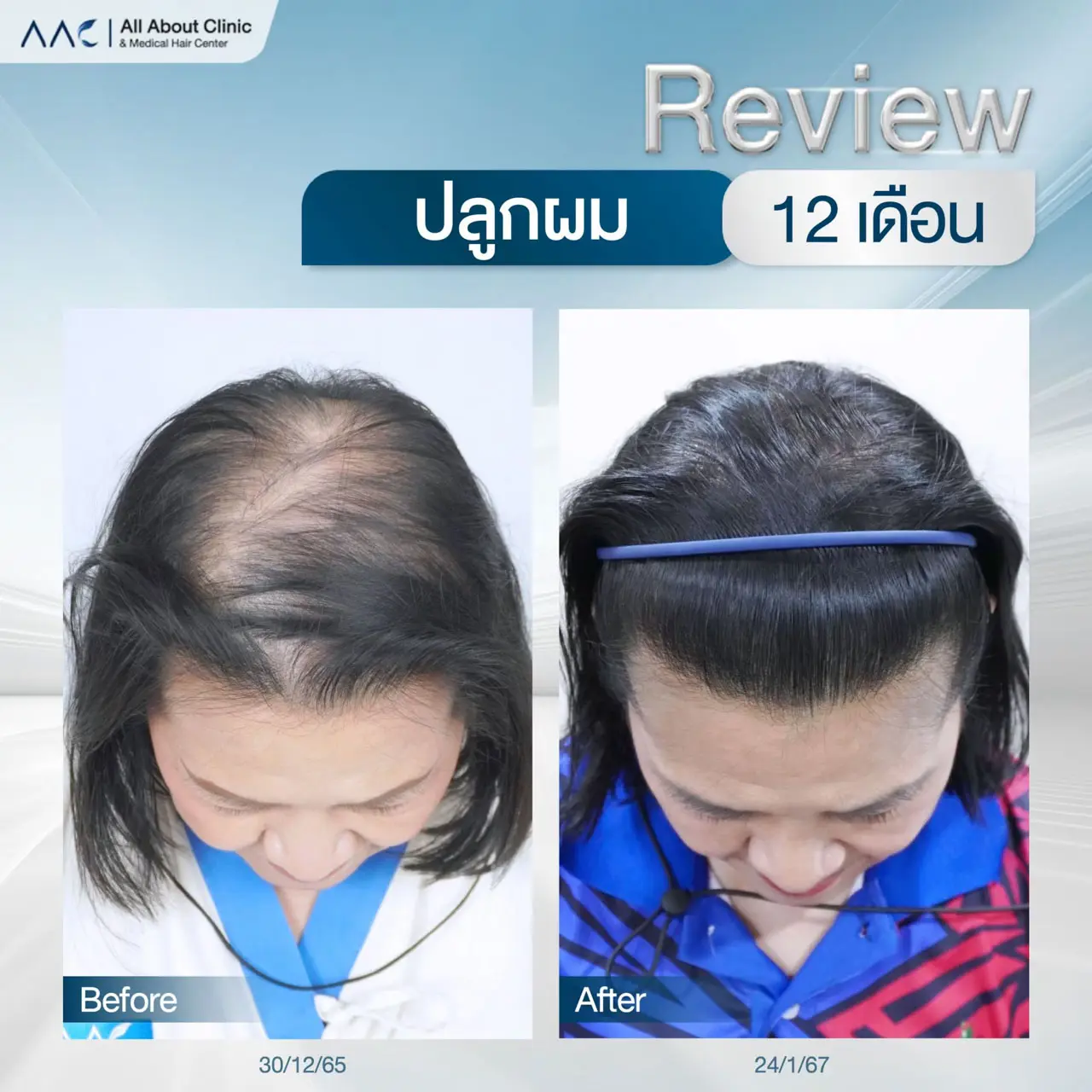 รีวิวหลังปลูกผม ผู้หญิง 1 ปี แก้แสกผมกว้าง