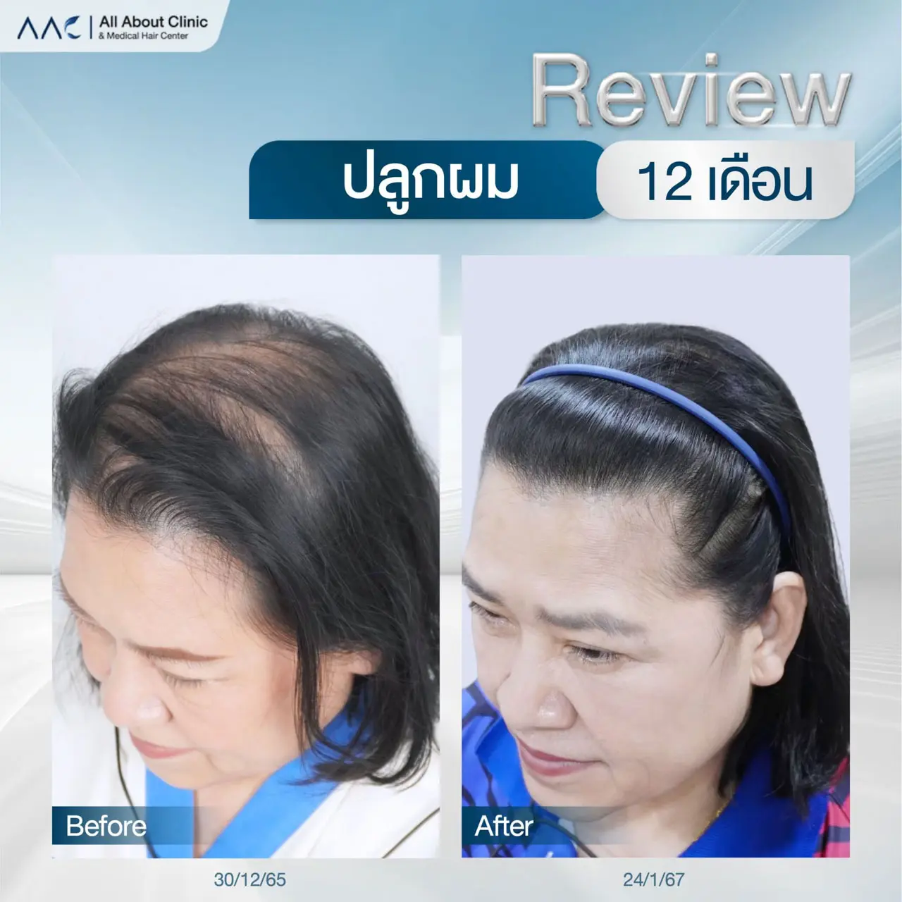 รีวิวหลังปลูกผม ผู้หญิง 12 เดือน แก้แสกผมกว้างหรือบาง