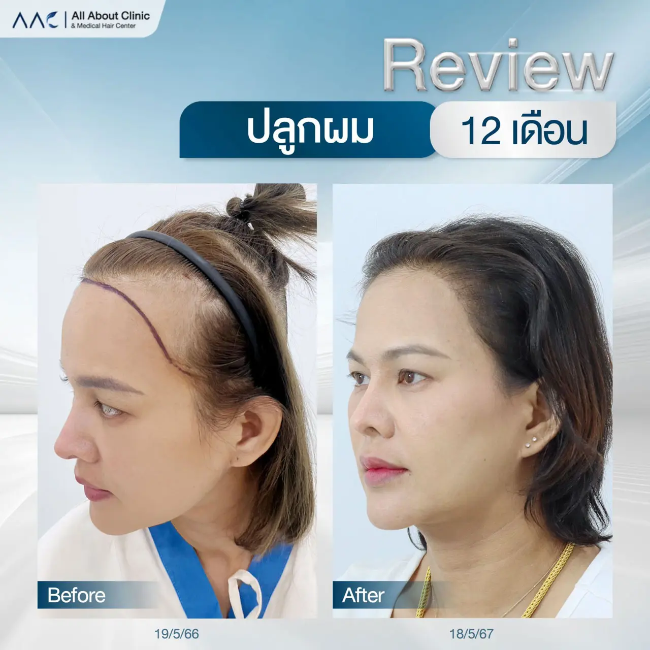รีวิวหลังปลูกผม ผู้หญิง 1 ปี