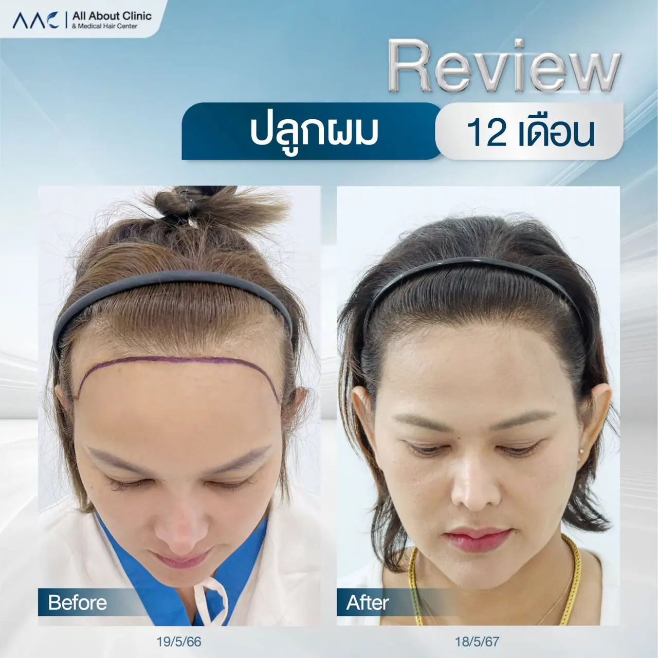 รีวิวปลูกผม ผู้หญิง มุมตรง 12 เดือน (1 ปี) ปรับกรอบหน้าให้ละมุน
