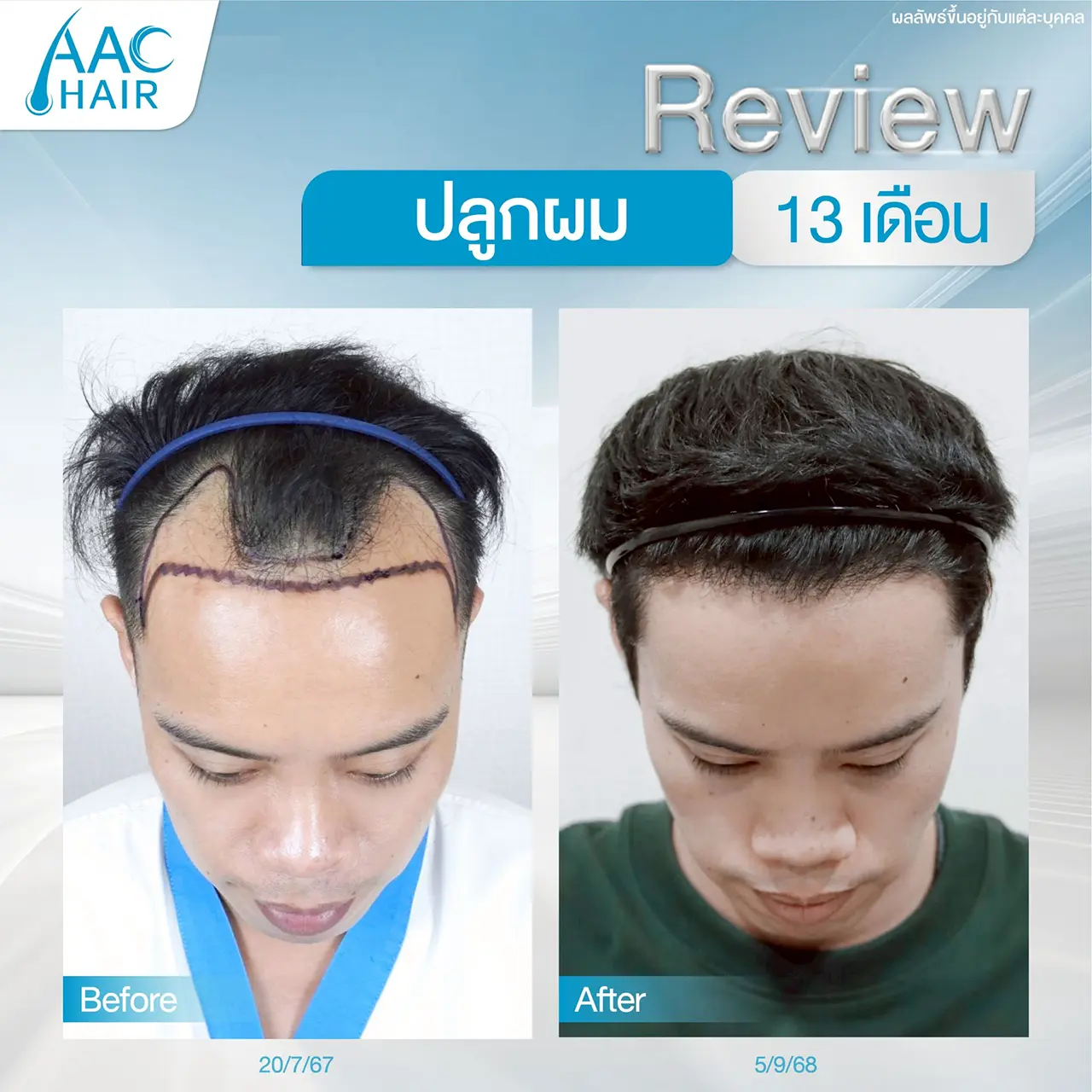 รีวิวหลังปลูกผมผู้ชาย 13 เดือน AAC HAIR