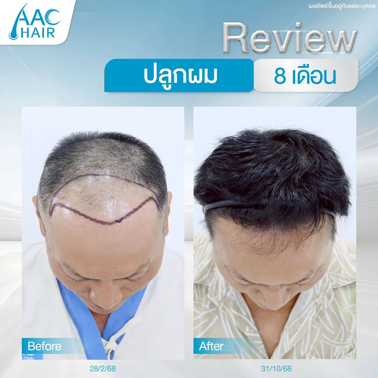 รีวิวหลังปลูกผมผู้ชาย 8 เดือน AAC HAIR