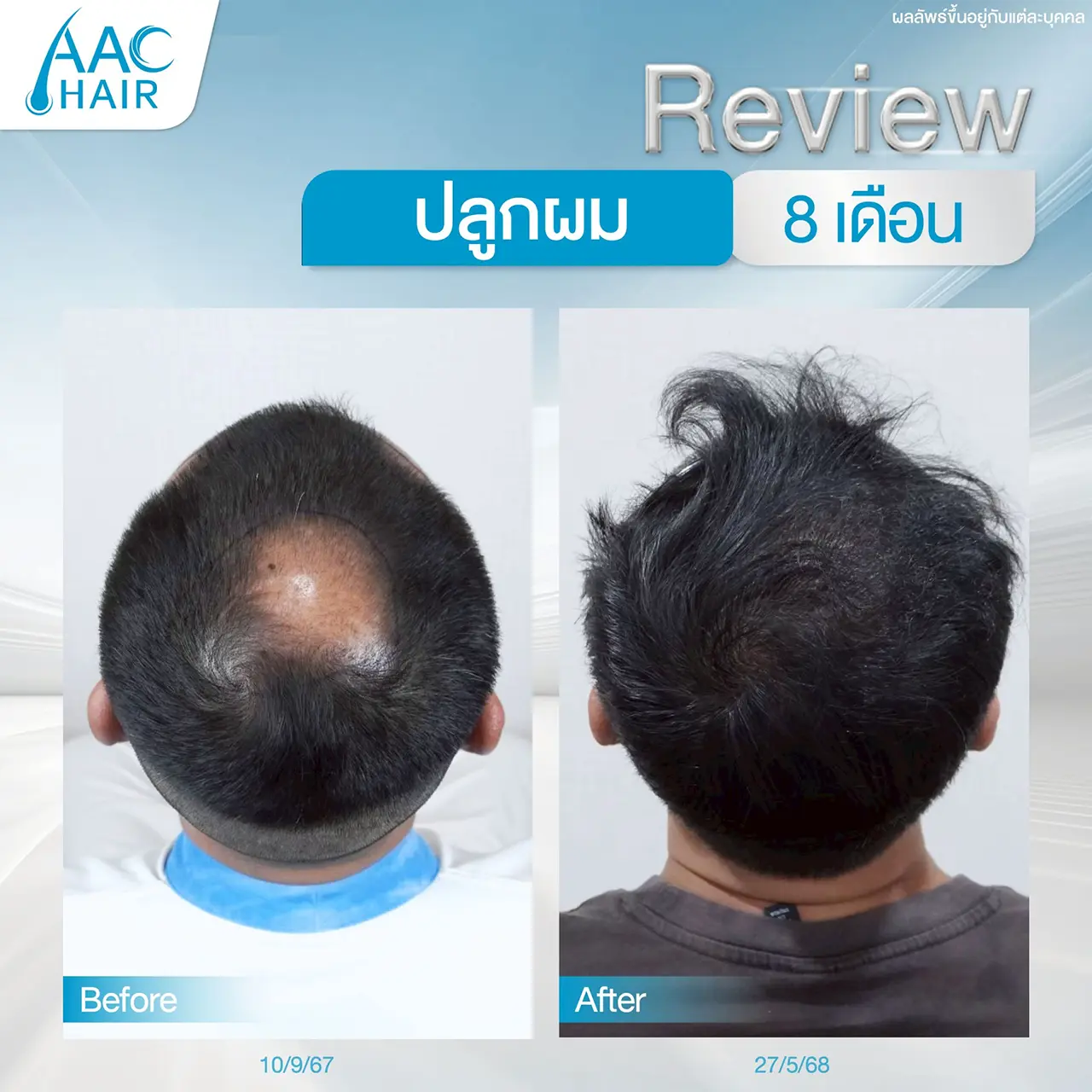 รีวิวหลังปลูกผมผู้ชาย 8 เดือน แก้กลางศีรษะล้าน