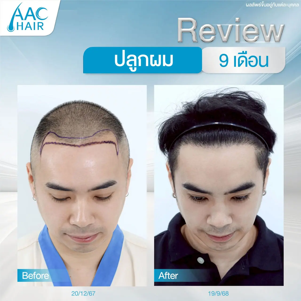 รีวิวปลูกผม ผู้ชาย หลังครบ 9 เดือน