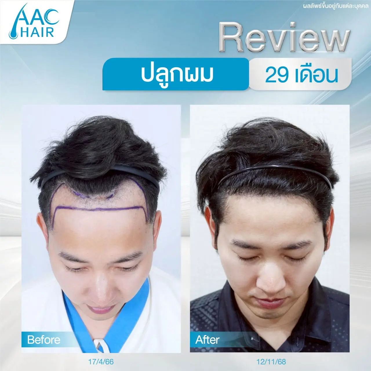 รีวิวปลูกผม ผู้ชาย หลังครบ 29 เดือน (2 ปี 5 เดือน)