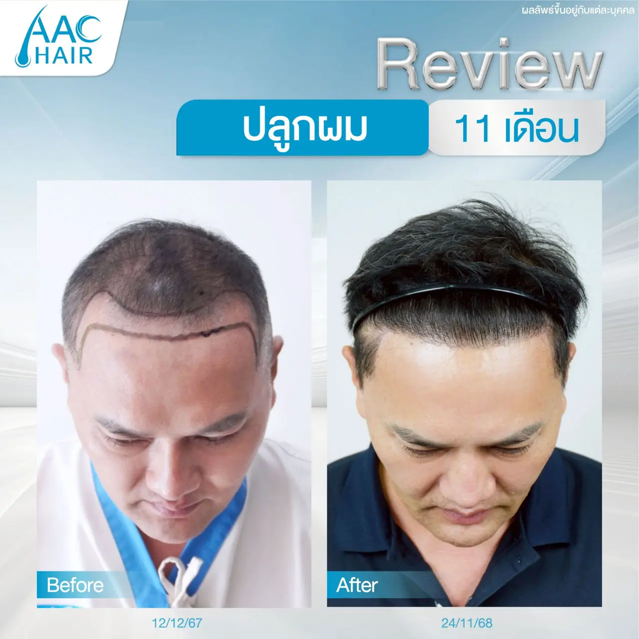 รีวิวปลูกผม ผู้ชาย หลัง 11 เดือน