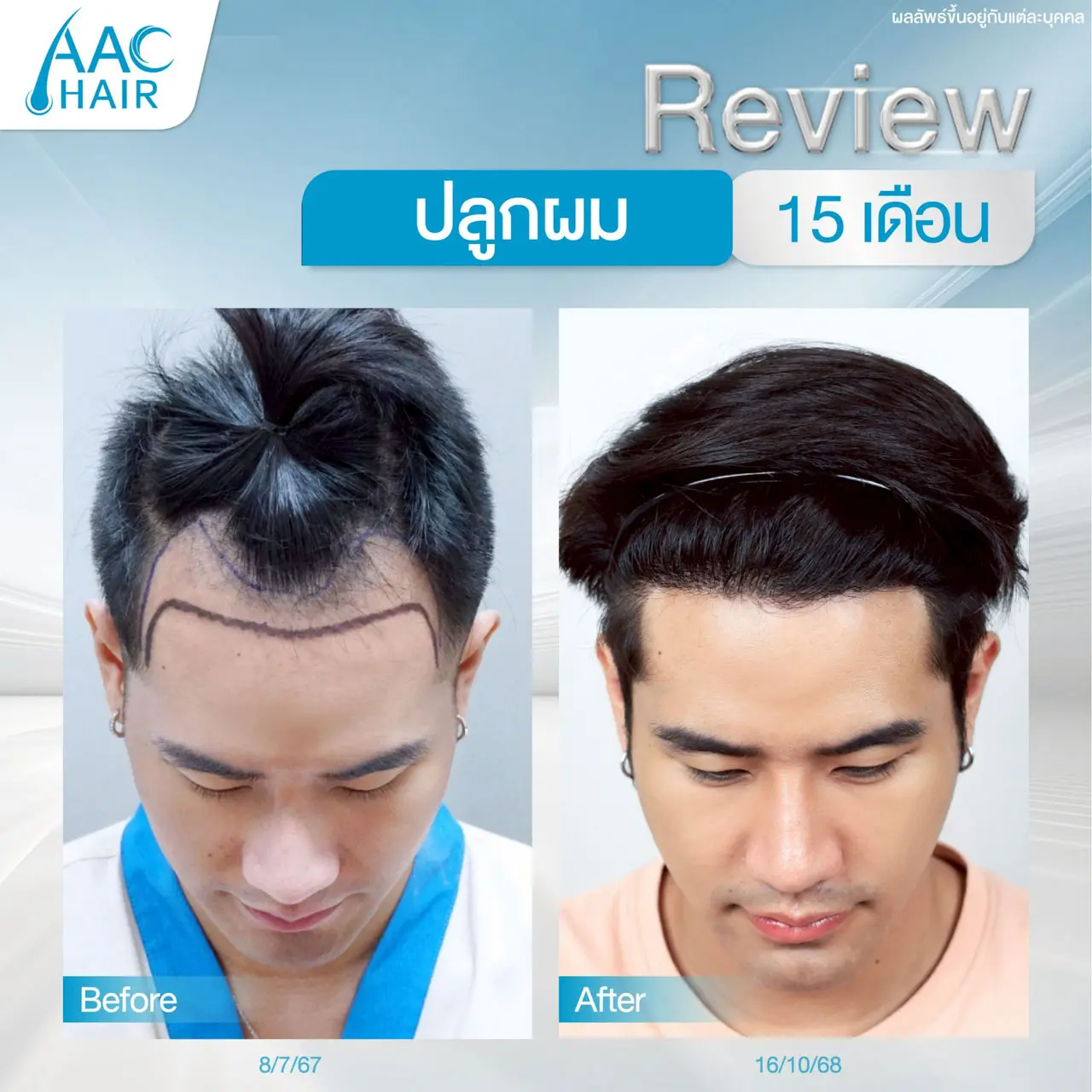 รีวิวปลูกผม ผู้ชาย หลัง 15 เดือน