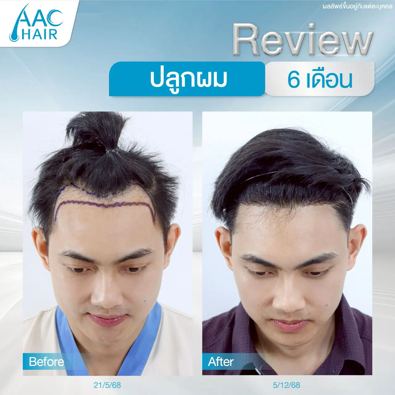 รีวิวปลูกผม ผู้ชาย หลัง 6 เดือน