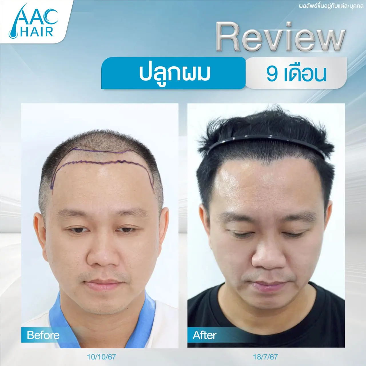 รีวิวปลูกผม ผู้ชาย ครบ 9 เดือน แก้ผมร่วง ผมบาง ศีรษะล้าน