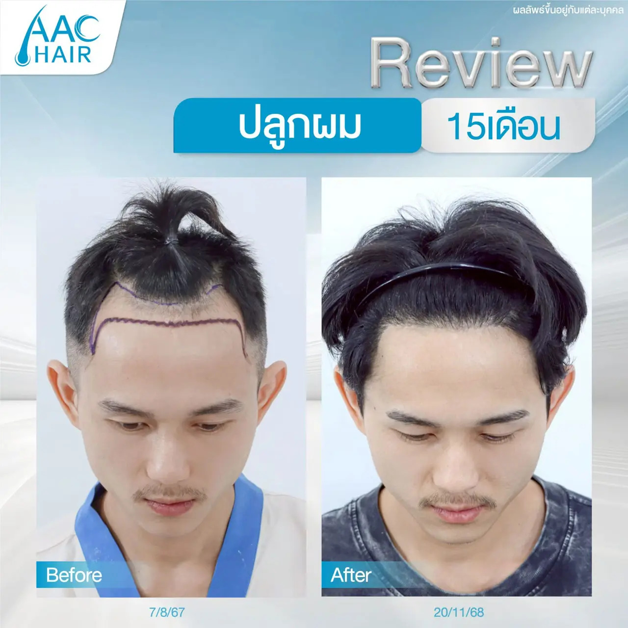รีวิวปลูกผม มุมหน้า ผู้ชาย 15 เดือน ผมดกหนา ดูอ่อนวัยลง