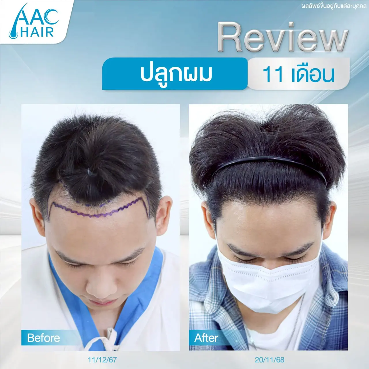 รีวิวปลูกผม ผู้ชาย 11 เดือน แนวผมได้สัดส่วน ดูอ่อนวัยลง