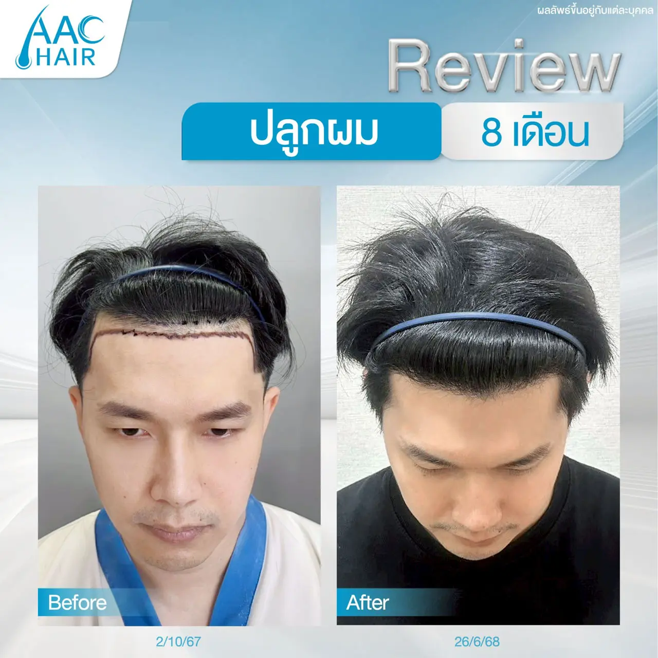 รีวิวหลังปลูกผมผู้ชาย 8 เดือน แก้ผมเว้าตัวเอ็ม