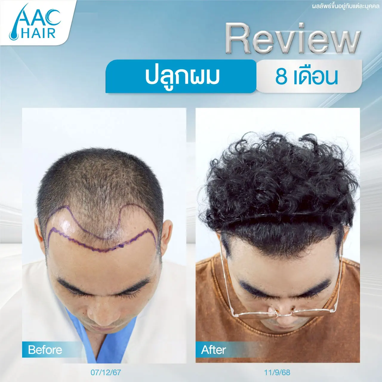 รีวิวหลังปลูกผมผู้ชาย 8 เดือน ผลลัพธ์ธรรมชาติ