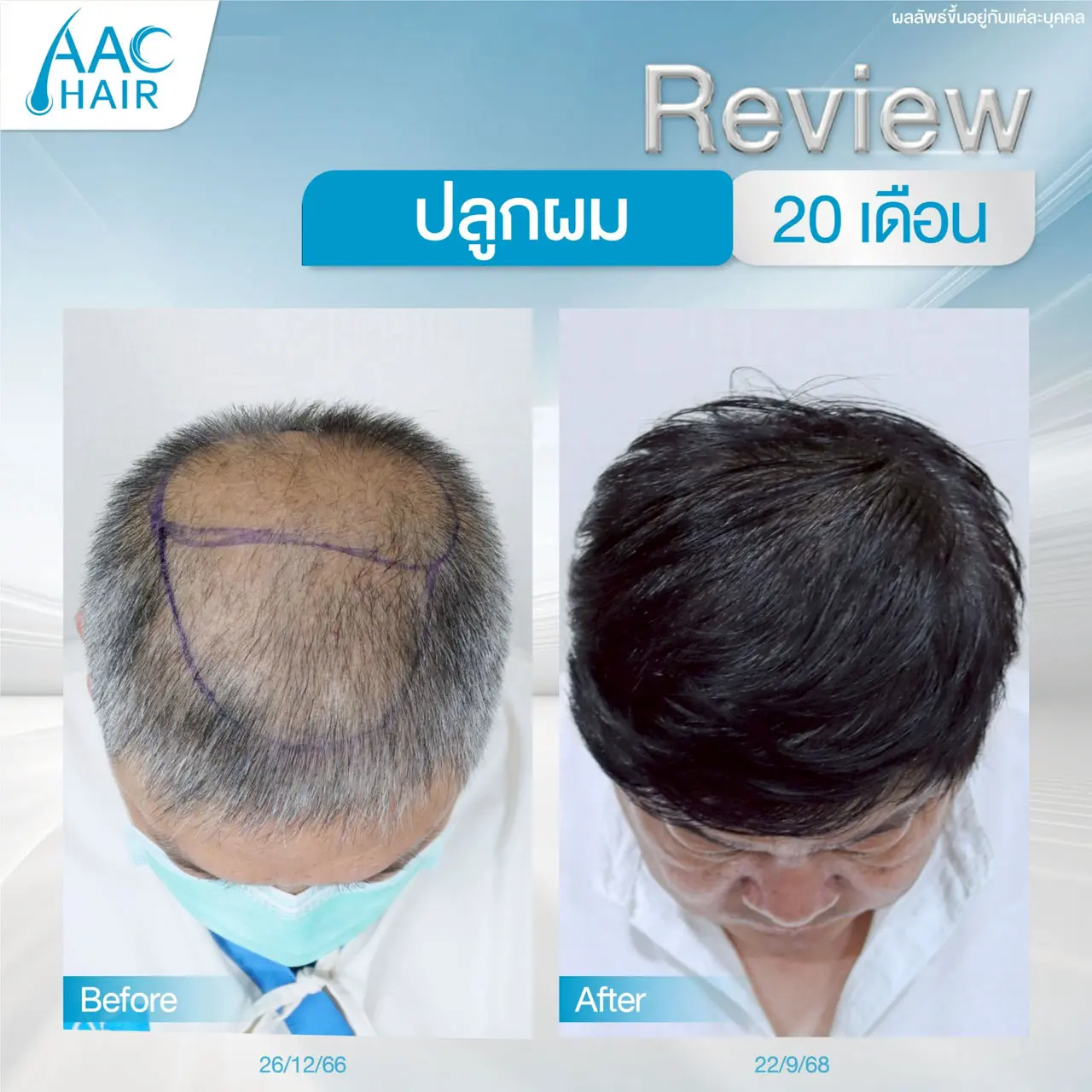 รีวิวปลูกผมผู้ชาย 20 เดือน เน้นบริเวณกลางศีรษะ