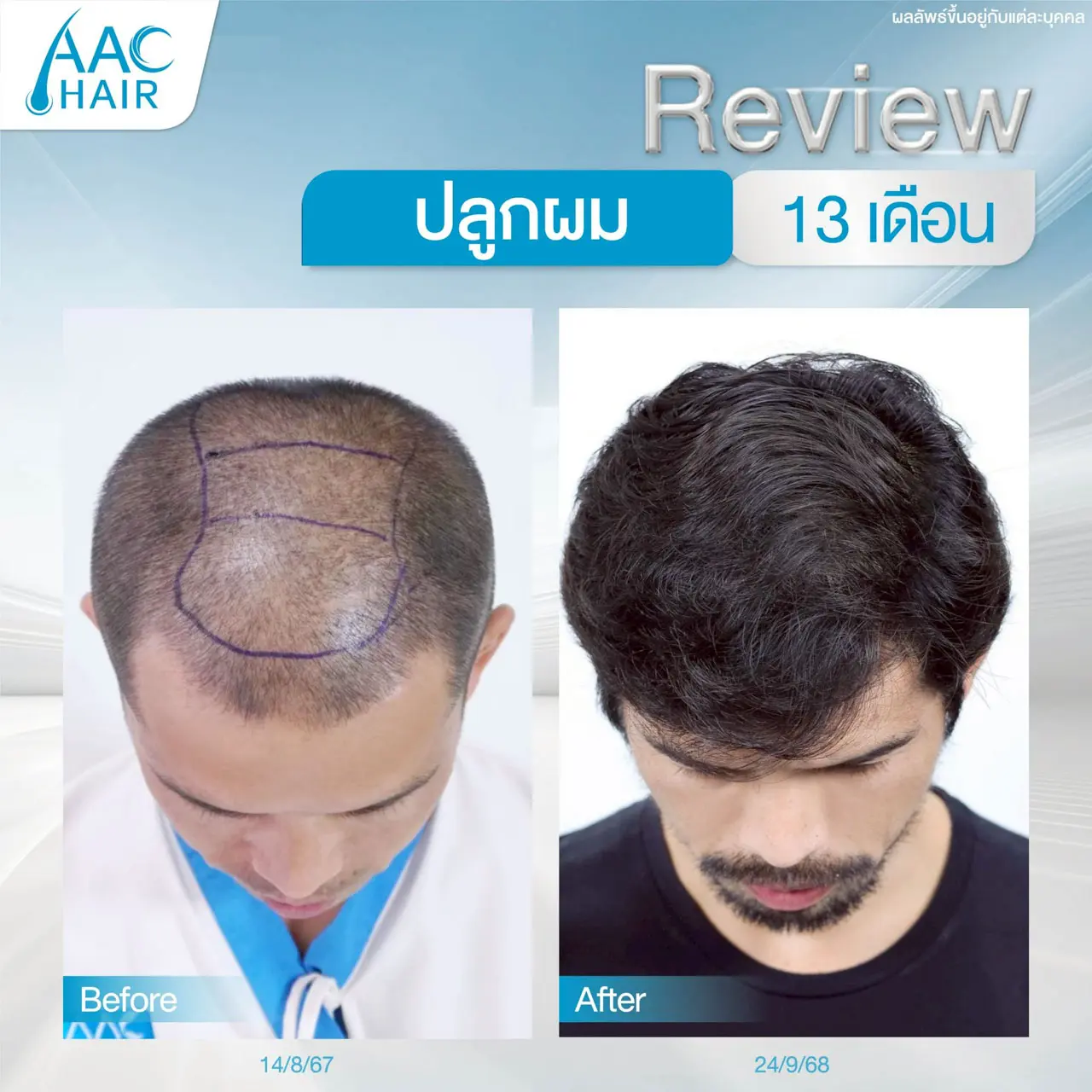 รีวิวหลังปลูกผมผู้ชาย 13 เดือน ผมดกหนาขึ้น
