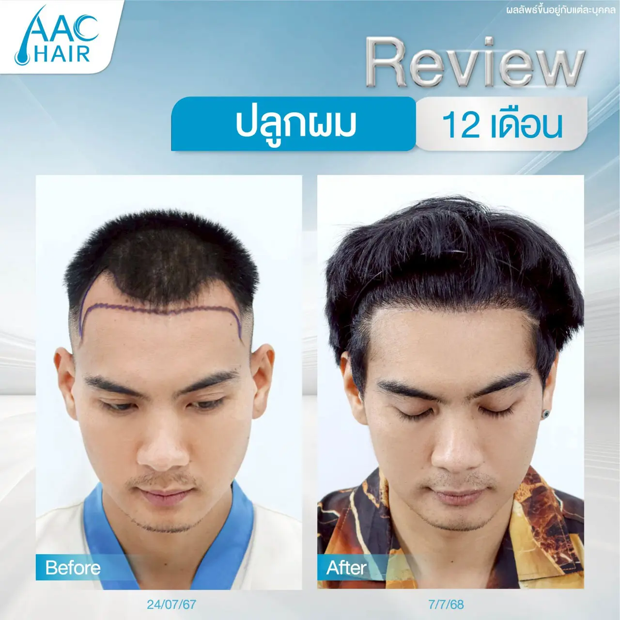 รีวิวหลังปลูกผมผู้ชาย 12 เดือน (1 ปี)