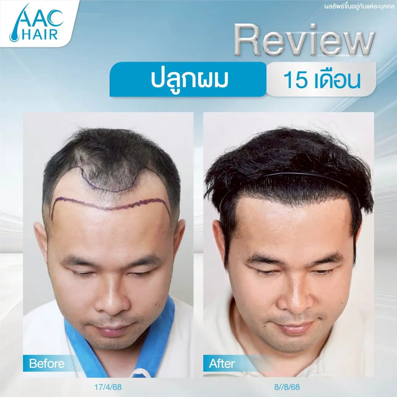 รีวิวปลูกผม ผู้ชาย หลังครบ 15 เดือน
